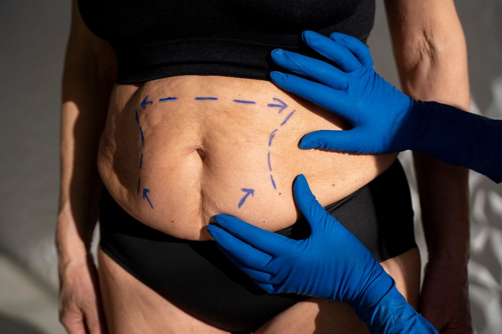 cirugia plastica de abdomen